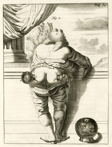 An example of cupping, from Exercitationes Practicae circa Medendi Methodum by Frederik Dekkers, 1694 by Dutch School