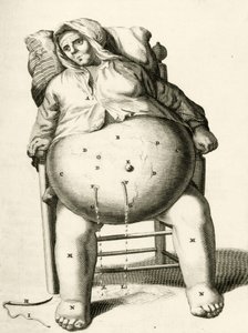 Draining fluids from an abscess, from Exercitationes Practicae circa Medendi Methodum by Frederik Dekkers, 1694 by Dutch School