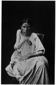 Photograph of a patient suffering from hemiplegic epilepsy, in 