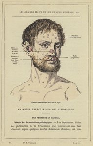 Characteristic Accidents of Acute Glanders by French School