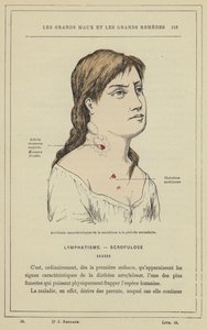 Characteristic accidents of scrofula in the secondary period by French School