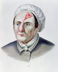 After a Skin Graft Operation, from Selecta Praxis Medico-Chirurgica by Alexander Auvert, Paris, 1856