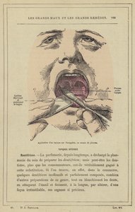 Application of a Topical Agent on the Tonsil, Using a Brush by French School