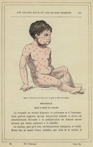 Aspect and Distribution of Measles Spots at the Beginning of the Eruption by French School