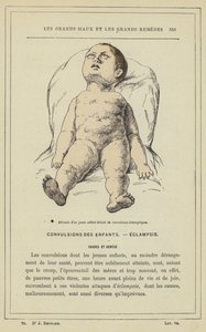 Attitude of a Young Child Suffering from Eclamptic Convulsions by French School