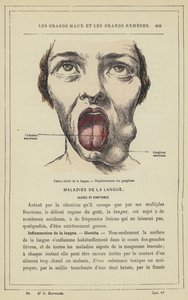 Ulcerated Cancer of the Tongue, Degeneration of the Glands by French School
