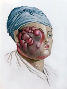 Cancerous scrofula, from Description des Maladies de la Peau by Baron Jean Louis Alibert