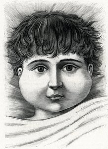 Child with mumps disease (engraving) 1888 by French School