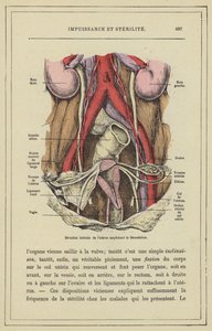 Lateral Deviation of the Uterus Preventing Fertilization by French School