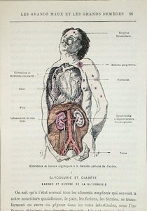 Effects of diabetes, from 