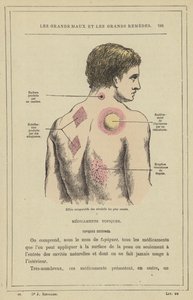 Comparative effects of the most common revulsives by French School