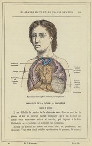 Pleural Effusion Caused by Pleurisy by French School