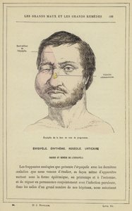 Progressing Facial Erysipelas by French School