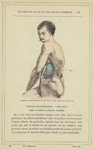 Characteristic Swelling of the Spleen During a Malarial Fever by French School