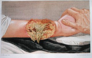 Hospital Gangrene, from 