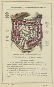 Inflammation of the Large Intestine, Characteristic Lesions of Dysentery by French School