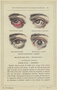 Superficial Eye Inflammations, Ophthalmies by French School