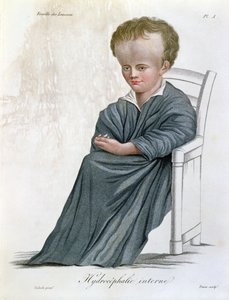 Internal Hydrocephalus, from Nosologie Naturelle by Baron Jean Louis Alibert engraved by Tresca