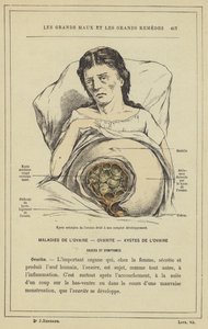 Areolar cyst of the right ovary at its complete development by French School