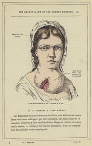 Partitioned Serous Cyst of the Neck, Head Lipoma by French School