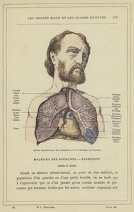 Characteristic Lesions of Bronchitis and Bronchial Dilation by French School
