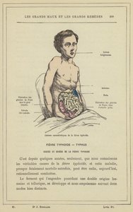 Characteristic Lesions of Typhoid Fever by French School