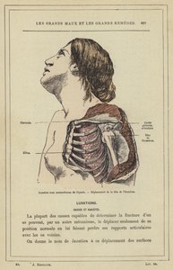 Subcoracoid dislocation of the shoulder, displacement of the head of the humerus by French School
