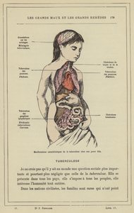 Characteristic Manifestations of Tuberculosis in a Young Girl by French School