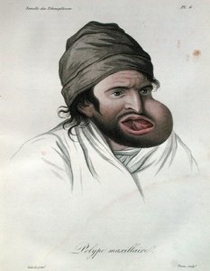 Maxillary polyp, from a book by Baron Jean Louis Alibert