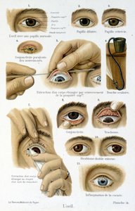 Medicine: the eye by French School