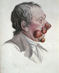 Mycosis Fongoide, from a book by Baron Jean Louis Alibert