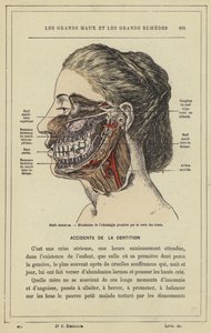 Dental Nerves, Mechanism of Toothache Caused by Tooth Decay by French School