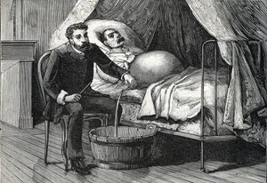 Patient with advanced liver cirrhosis, doctor performing a puncture (engraving, 1888)