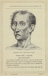 Appearance of the Patient in the Asphyxial Stage of Cholera by French School