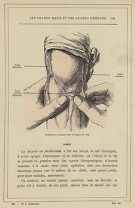 Position of the Lancet in Arm Bleeding by French School