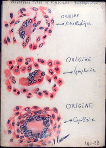 Principle tuberculosis follicles