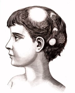 Ringworm on child (engraving) by French School