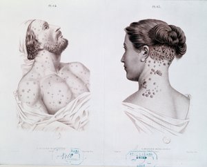 Symptoms of syphilis in men and women, from a medical book by French School