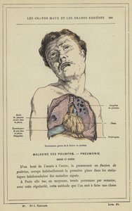 Severe Outcomes of Chest Fluxion by French School