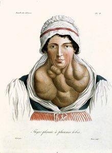 Thyroid disease, from a book by Baron Jean Louis Alibert 1817