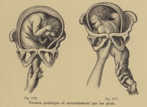 Delivering a Baby Feet First (Breech Birth) by German School