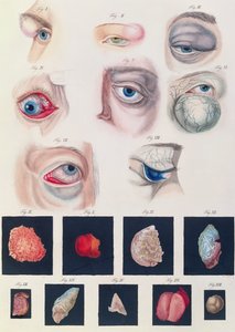 Description of congenital eye anomalies, from Klinische Darstellungen der Krankheiten und Blidungsfehler des Menschlichen Auges, by Friedrich August von Ammon, 1838
