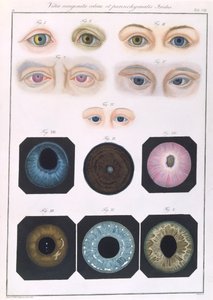 Description of congenital eye anomalies, from Klinische Darstellungen der Krankheiten und Blidungsfehler des Menschlichen Auges, by Friedrich August von Ammon, 1838 by German School
