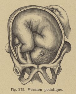 Podalic Version During Childbirth by German School