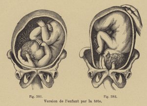 Turning a Baby in Its Mother