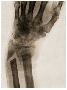 X Ray of a Fractured Wrist