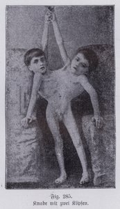 Giacomo and Giovanni Battista Tocci, Italian Conjoined Twins