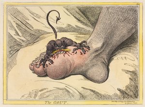 The Gout, 1799 by James Gillray