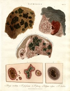 Pathological Skin Changes: Porriga and Ecthyma by John Pass