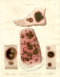 Pathological Skin Conditions - Pityria, Impetigo and Syphilis